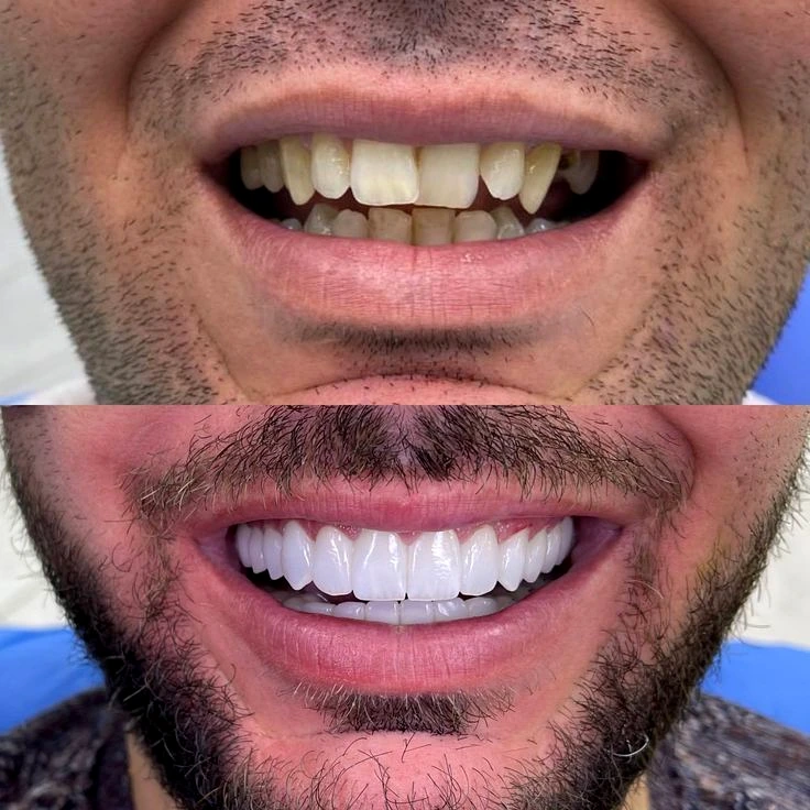 Antes e depois de tratamento odontológico