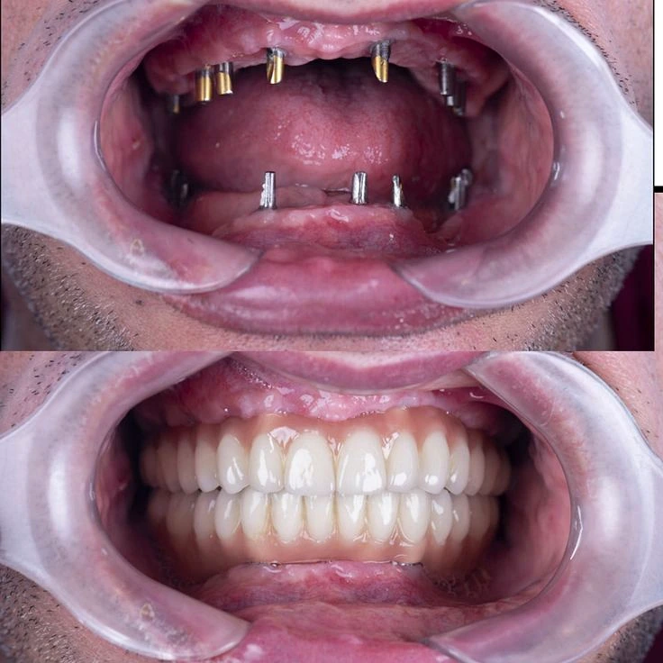 Antes e depois de reabilitação com implantes