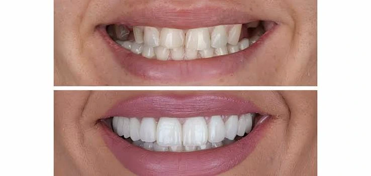 Antes e depois de transformação do sorriso