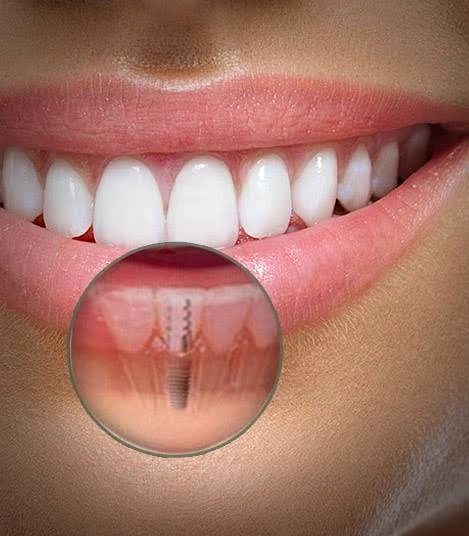 Implante dentário com sorriso finalizado